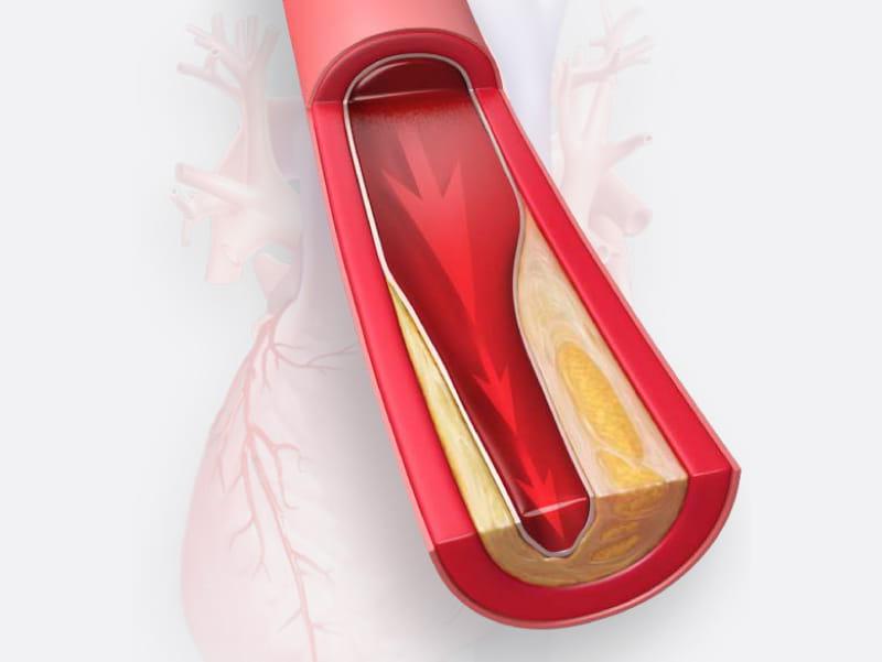 Image of artery narrowed with cholesterol. (美国心脏协会斯科特·博德尔)